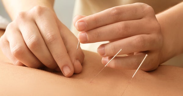 up close of young man getting acupuncture in the middle of his back