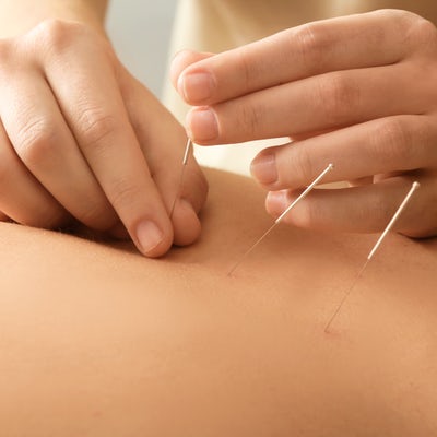 up close of young man getting acupuncture in the middle of his back